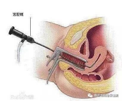 宫腔镜.jpg